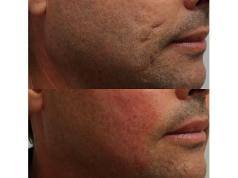 Acne Scar Breakthroughs!